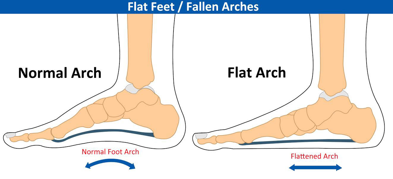 flat feet need arch support